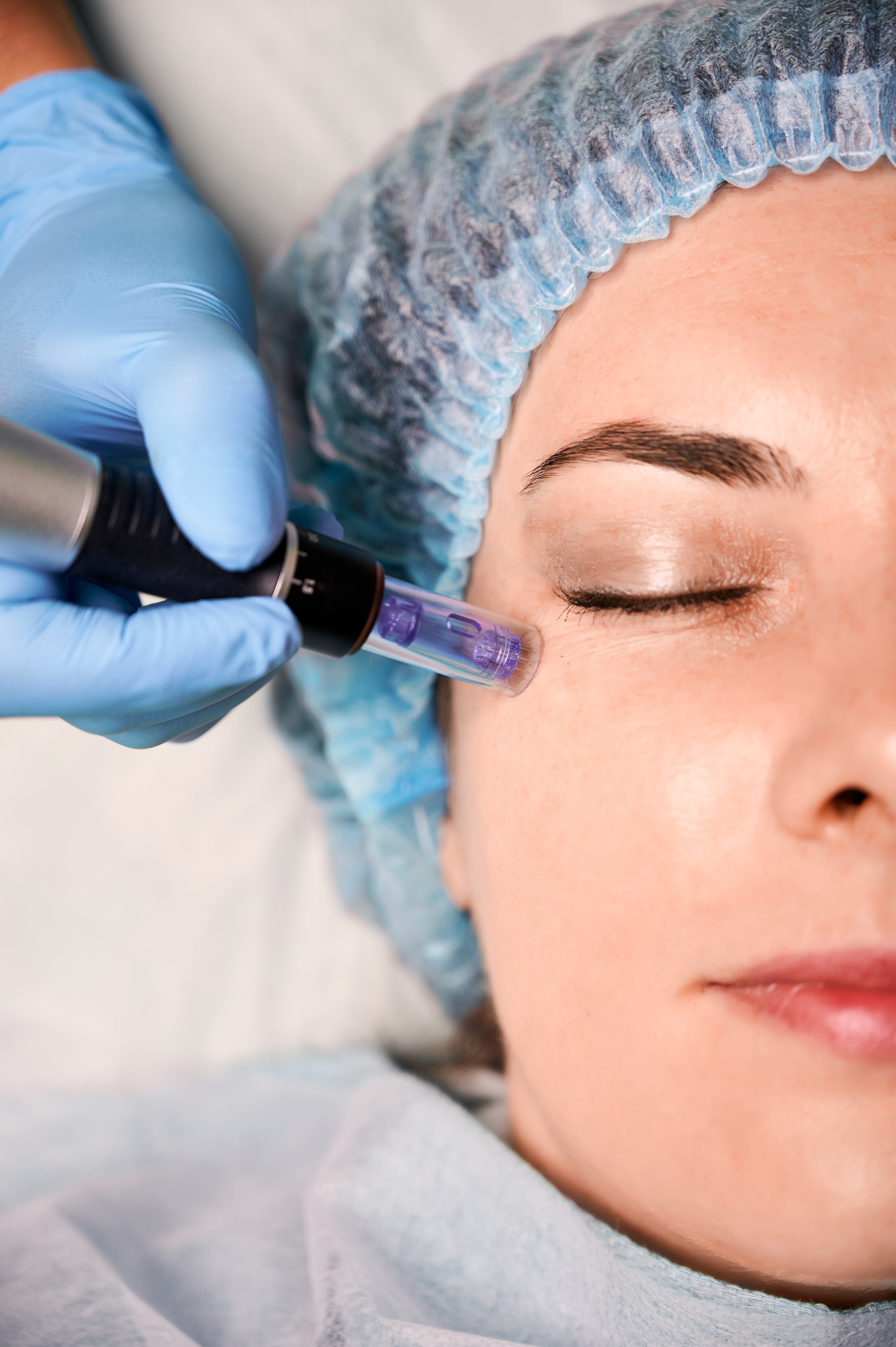 Enzimas Bioactivas Aplicadas a Travéz de terapia por Micropunción
